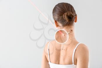 Young woman undergoing procedure of nevus removal by laser on light background�