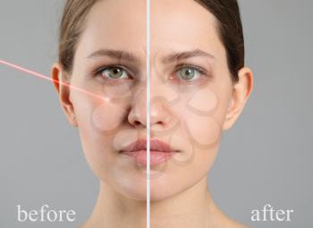Face of young woman before and after treatment by laser on grey background�