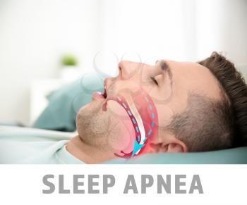 Illustration showing airway during obstructive sleep apnea�