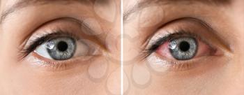 Young woman without and with eye redness, closeup�
