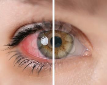 Young woman with and without eye redness, closeup�