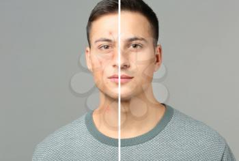 Young man with and without acne problem on grey background�
