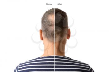 Man before and after hair loss treatment on white background�