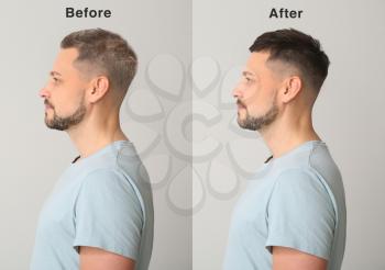 Man before and after hair loss treatment on grey background�