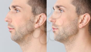 Young man before and after plastic operation on light background�