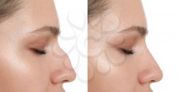 Woman before and after rhinoplasty on white background�