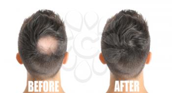 Man before and after hair loss treatment on white background�