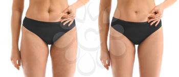 Young woman before and after anti-cellulite treatment on white background�