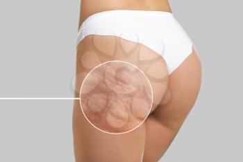 Young woman with cellulite problem on light background�