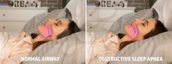 Illustrations showing difference between normal breathing and obstructive sleep apnea�