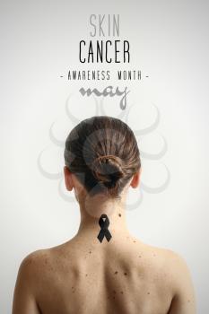 Young woman with moles and text SKIN CANCER AWARENESS MONTH on light background�
