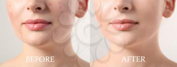 Young woman before and after acne treatment on light background, closeup�