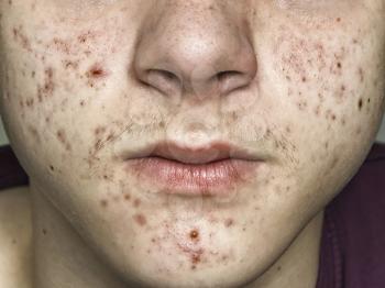 teenage acne on the face close up