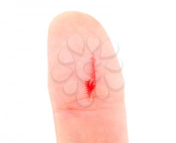 Royalty Free Photo of a Sore on a Finger