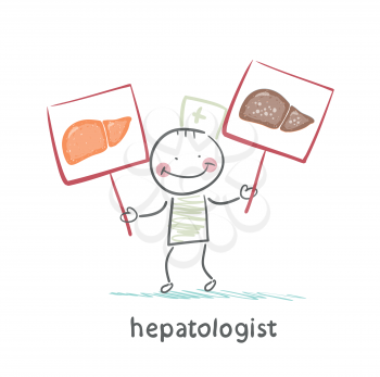 hepatologist holding signs with healthy and diseased liver