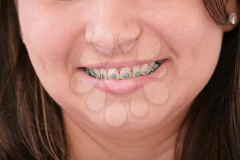 teeth with braces 