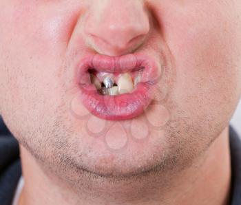 Young man face with tooth pin in mouth
