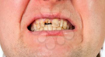 Young man mouth with broken tooth, closeup view isolated on white
