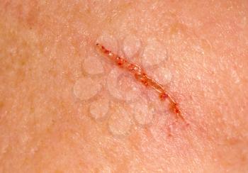 wound on the skin. macro