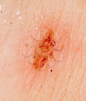 Wound on the skin of a person. macro