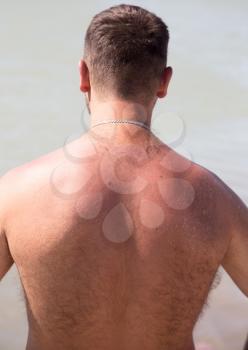 Red skin tan on the back of a man .