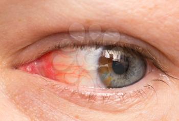 Chronic conjunctivitis eye with a red iris and pus close-up.