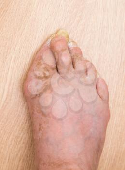 Fungus Infection on Nails of Man's Foot