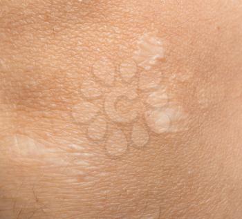 scar on the human skin