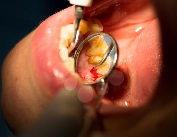 Doctor performs an operation on teeth in dentistry