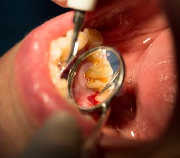 Doctor performs an operation on teeth in dentistry