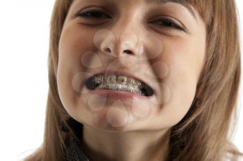 Royalty Free Photo of a Young Girl Showing Braces