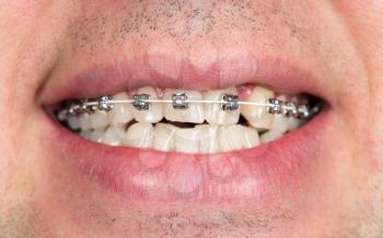 Close-up of braces on the teeth of the upper jaw with unshaven men