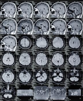 Magnetic resonance brain tomograma