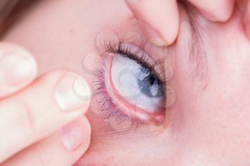 Close up of inserting a contact lens in female eye