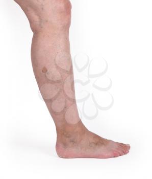 Old woman with varicose veins, isolated on white