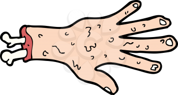 Royalty Free Clipart Image of an Amputated Hand