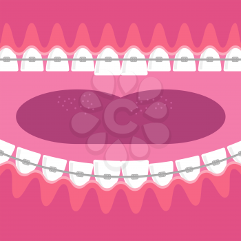 Medical Braces Teeth. Dental Care Background. Orthodontic Treatment. Cartoon Opening Mouth.