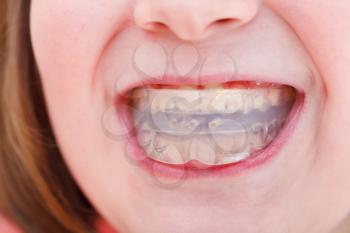 correction of children occlusion by pre-orthodontic trainer