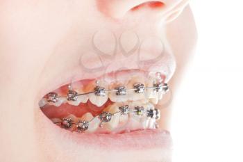 dental braces on teeth close up during orthodontic treatment