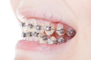 side view of dental braces on teeth close up during orthodontic treatment
