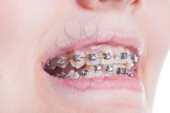 orthodontic braces on teeth close up during treatment