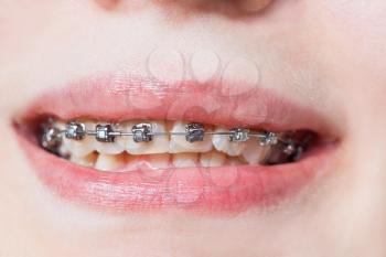front view of dental braces on teeth of upper jaw before Orthodontic Treatment