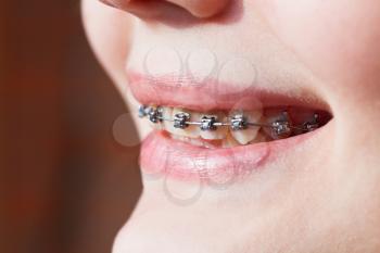 side view of dental braces on teeth of upper jaw before Orthodontic Treatment