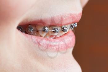 dental braces on teeth of upper jaw close up before Orthodontic Treatment