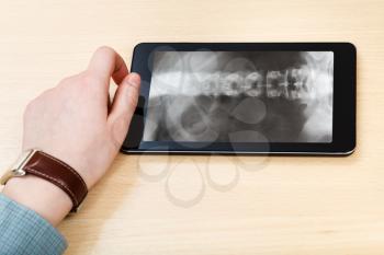 scientist analyzes X-ray picture of vertebral column on screen on tablet pc