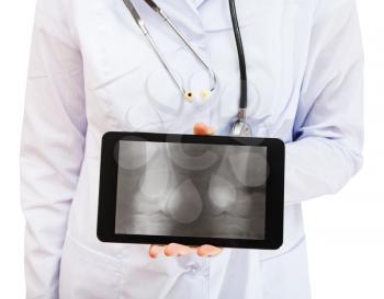 nurse holds tablet pc with X-ray picture of two human knee-joints on screen isolated on white background