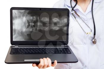 nurse holds computer laptop with X-ray picture of human spinal column on screen isolated on white background