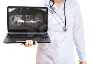 nurse holds computer laptop with X-ray picture of human teeth on screen isolated on white background
