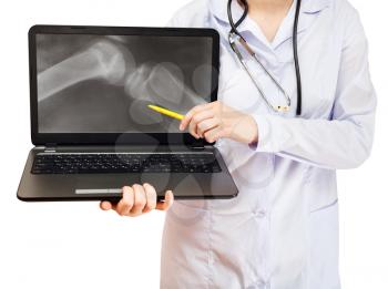 nurse points on computer laptop with X-ray picture of human knee joint on screen isolated on white background