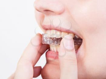 girl fixes transparent aligner for dental treatment